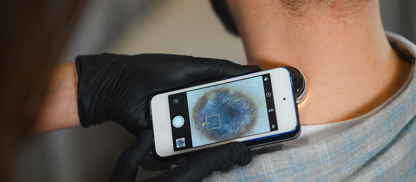 BRCC-Cancer-Sub-Banner-Melanoma-01