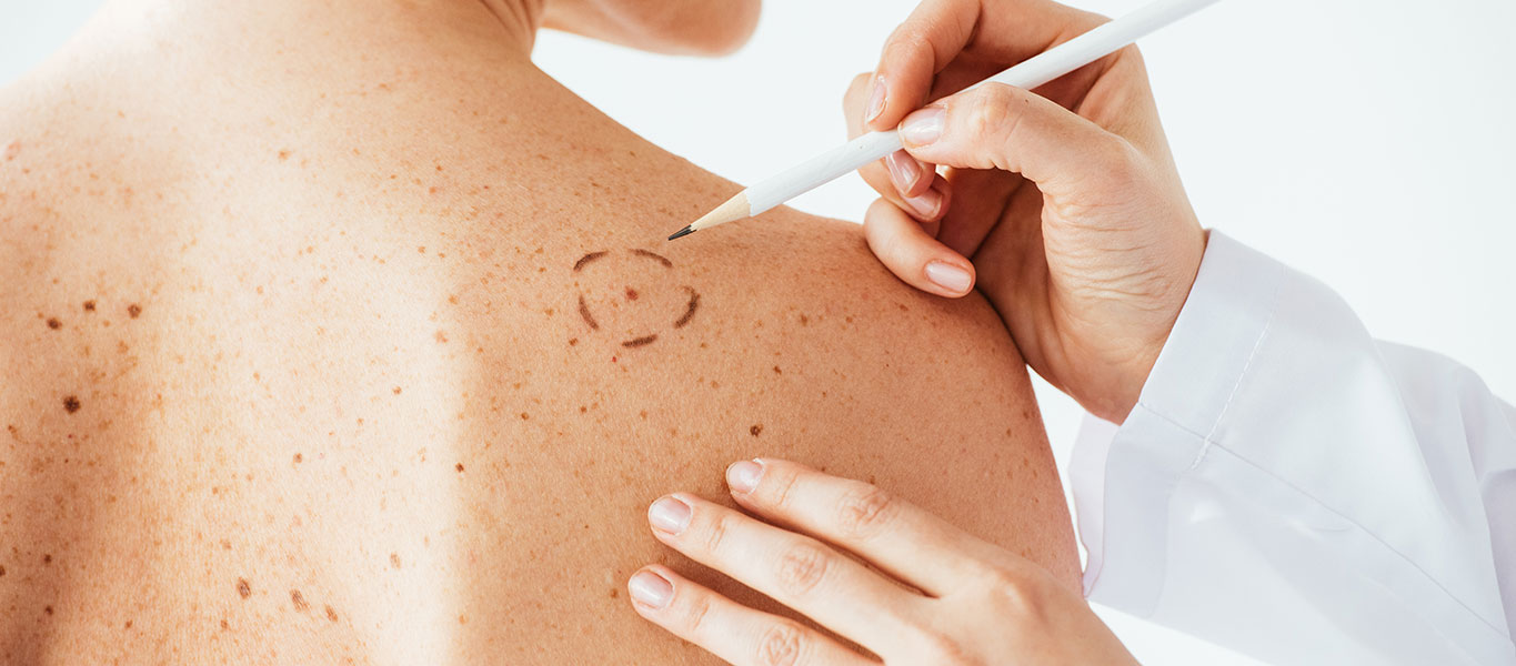 BRCC-Cancer-Sub-Banner-Non-Melanoma-Skin-01